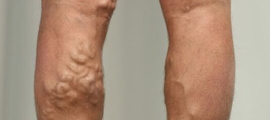 проширени вени на ногата