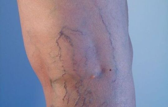 проширени вени на нозете кај жените