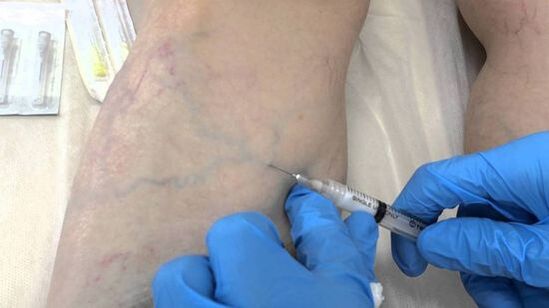 склеротерапија за проширени вени на нозете кај жените